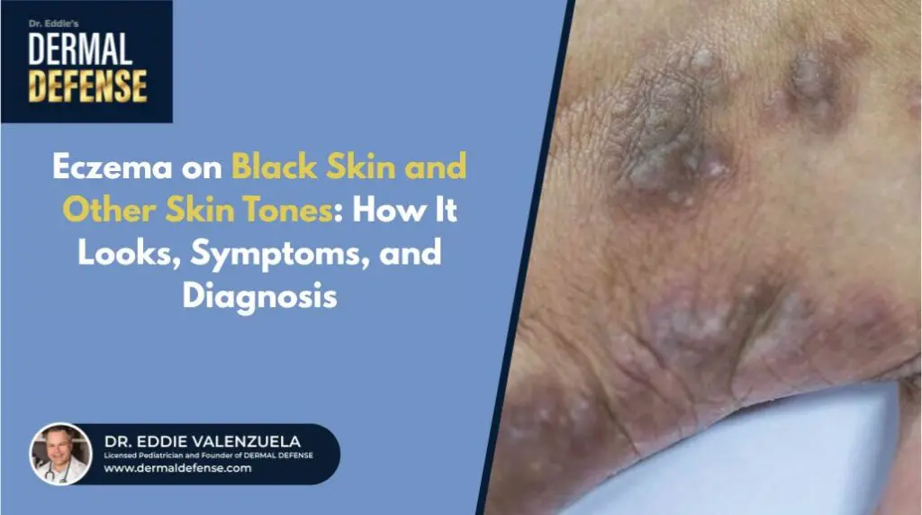 Eczema on Black Skin and Other Skin Tones: How It Looks, Symptoms, and Diagnosis.
