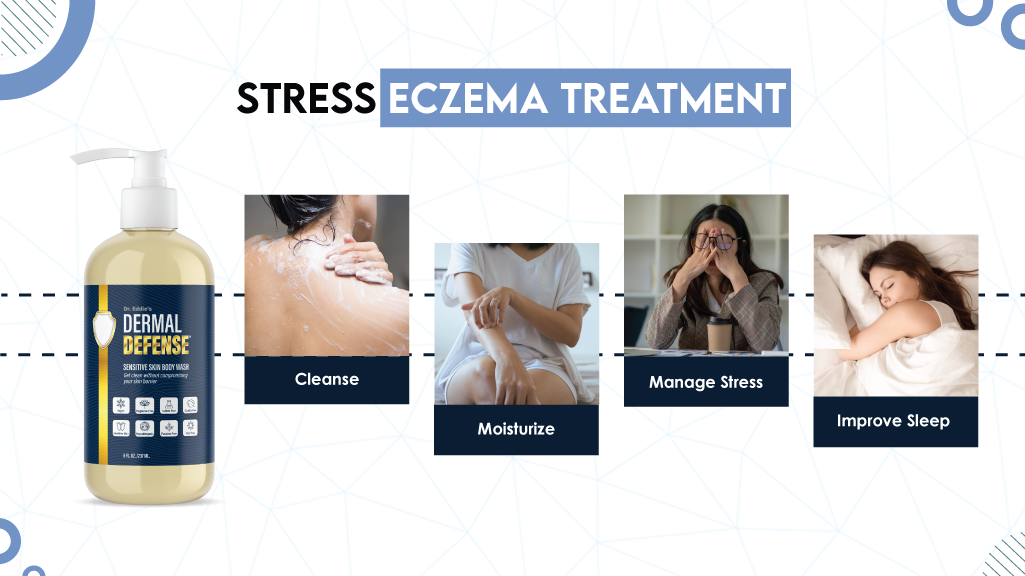Stress Eczema Treatment​. No matter what causes or triggers your eczema, the first thing you would want if you are experiencing it is to know how to get rid of eczema. 