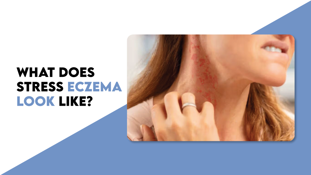It looks pretty much like what an eczema rash looks like. 