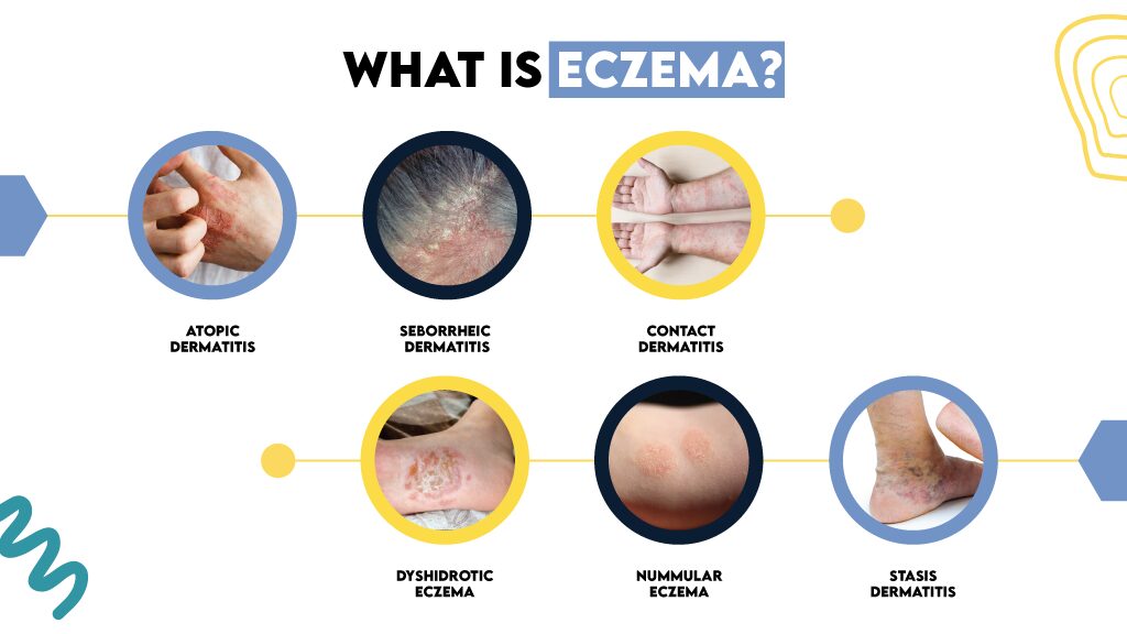 Eczema is a chronic skin condition causing red, itchy rashes and includes various types, including atopic dermatitis.