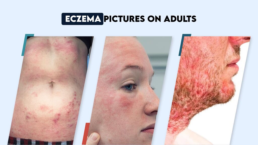 Adult eczema on different skin tones, see how redness and patches may appear.