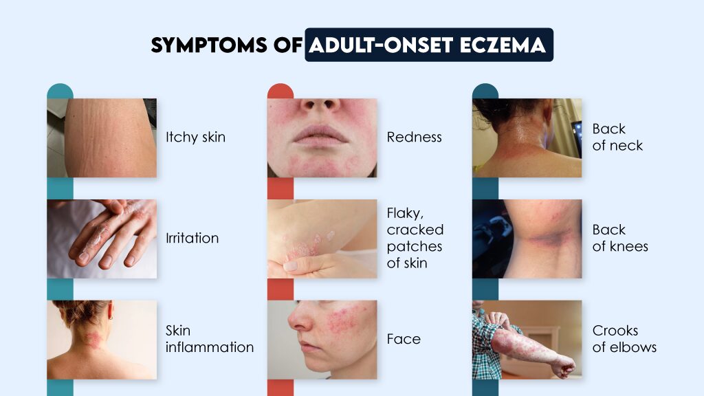 Itchy, red, flaky skin signs of adult eczema. Learn gentle care solutions.