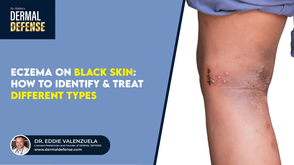 Eczema on Black Skin How to Identify & Treat Different Types