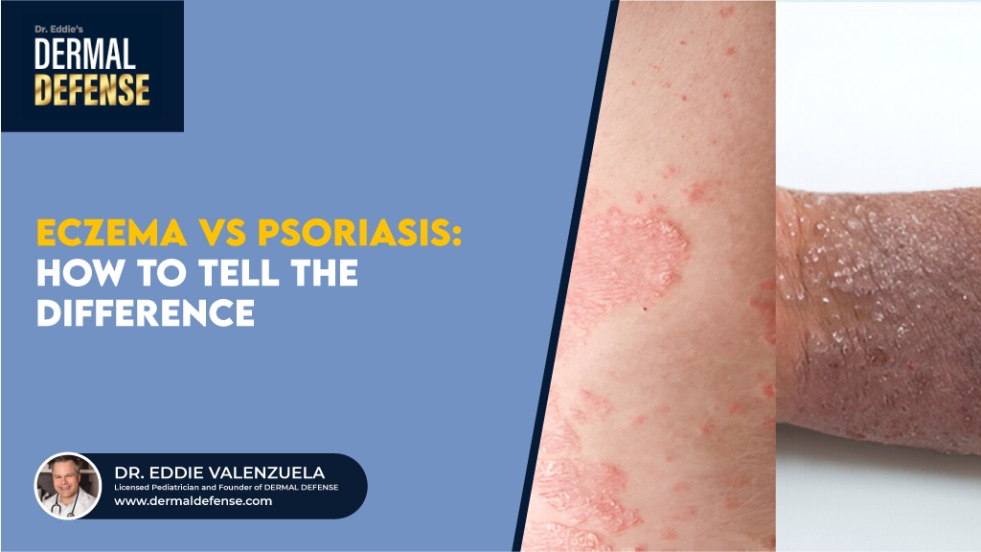 Psoriasis vs Eczema: How to Tell the Difference