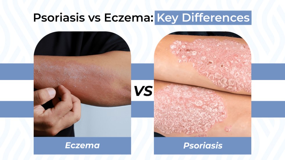 Psoriasis vs Eczema Key Differences
