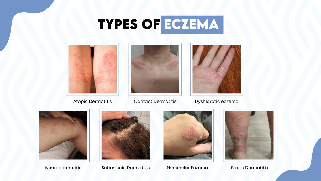 Most people don’t know, but there are 7 different types of eczema. The symptoms and treatment for each type of eczema may vary a little; however, almost all of these cause itching and irritation on the skin.