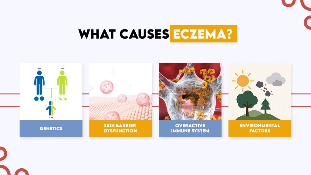 What Causes Eczema