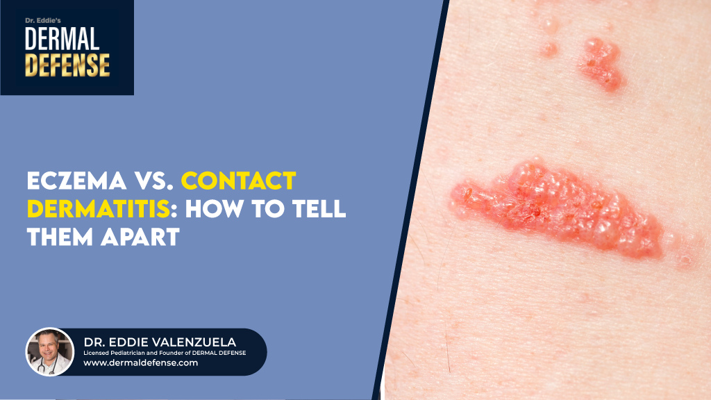 Eczema vs. Contact Dermatitis
