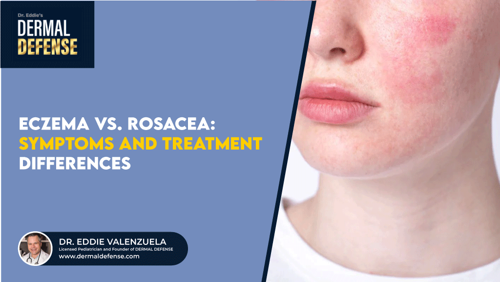 Eczema vs. Rosacea
