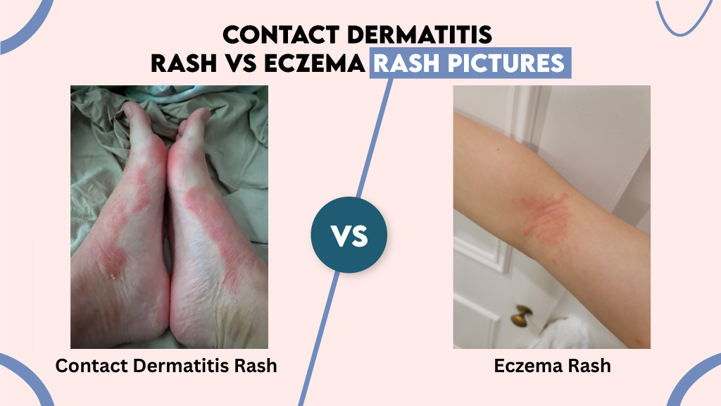 Contact Dermatitis Rash vs Eczema Rash