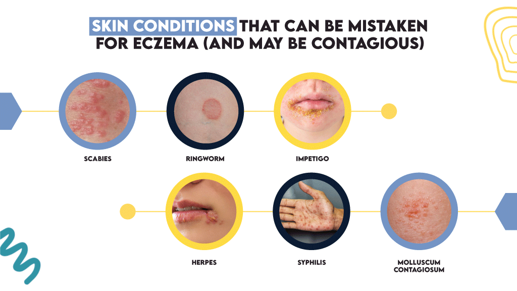 Skin Conditions That Can Be Mistaken for Eczema (and May Be Contagious)