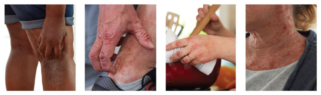 what does eczema look like on Black skin?”, the images above can help illustrate how eczema appears across different skin tones. Visual examples are especially helpful because eczema does not always look the same on everyone.