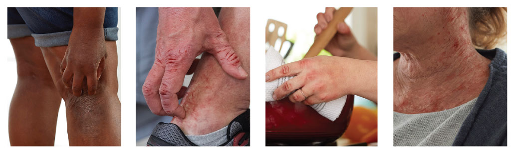 what does eczema look like on Black skin?”, the images above can help illustrate how eczema appears across different skin tones. Visual examples are especially helpful because eczema does not always look the same on everyone.