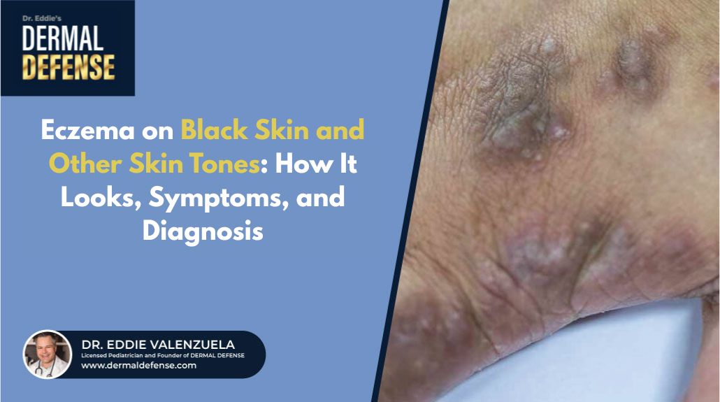 Eczema on Black Skin and Other Skin Tones: How It Looks, Symptoms, and Diagnosis.