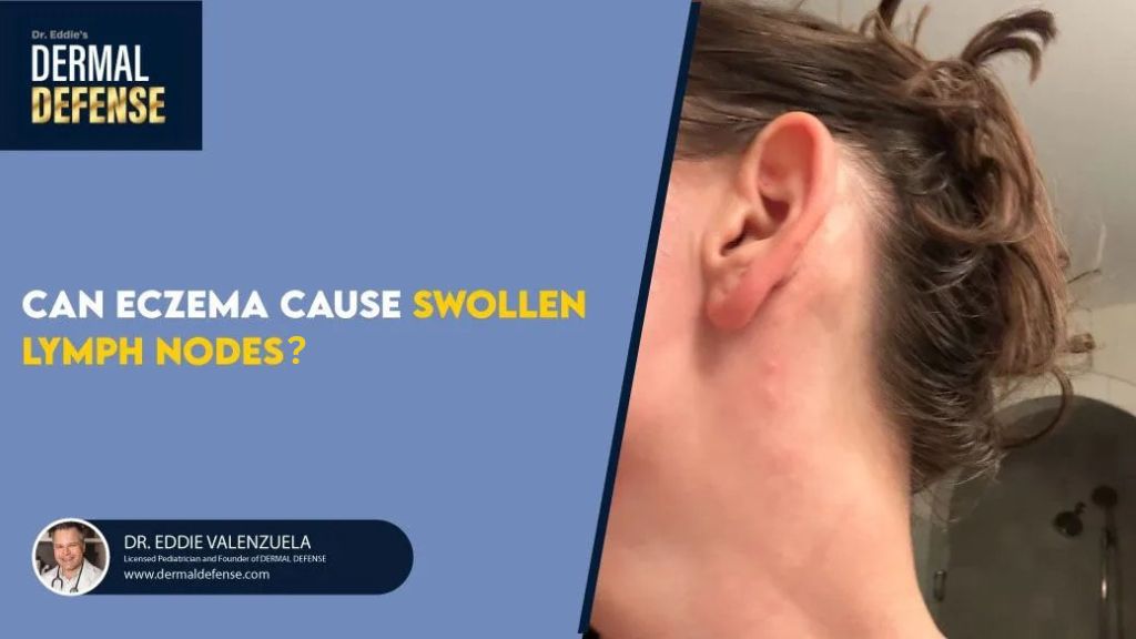 Eczema can be associated with swollen lymph nodes, but usually only in more severe cases or when infection or significant inflammation is present. In most cases, swelling is a sign of immune system activity rather than eczema itself.
